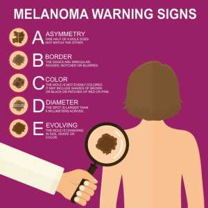 Melanoma warning signs 